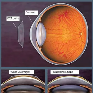 友华普惠眼科OK镜 友华普惠眼科OK镜